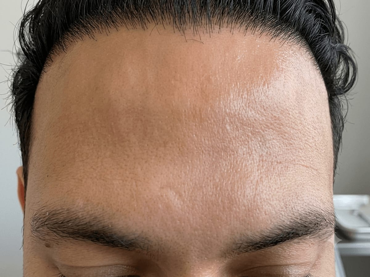 Sesión de inyección de Botox en Zen Skin Studio
