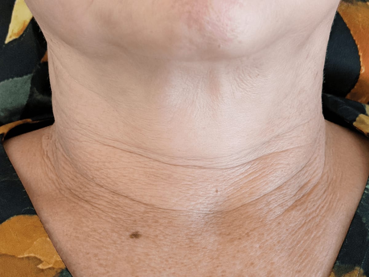 Sesión de lifting de cuello en Zen Skin Studio