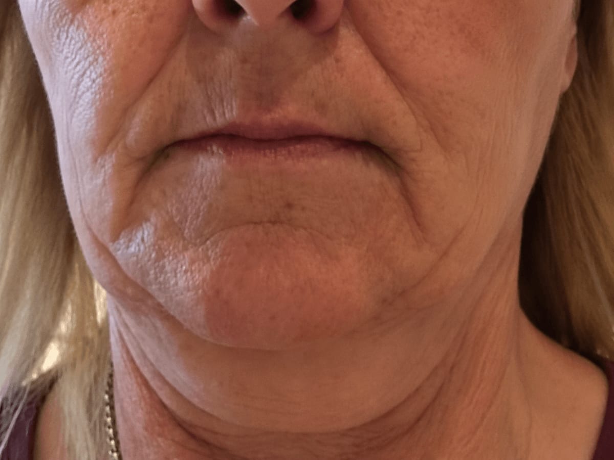 Lifting facial en Zen Skin Studio