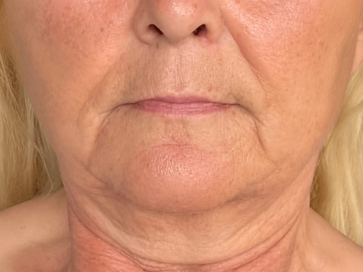 Sesión de lifting facial en Zen Skin Studio